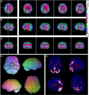 SPECT Functional Neuroimaging Distinguishes Adult Attention Deficit Hyperactivity Disorder From Healthy Controls in Big Data Imaging Cohorts